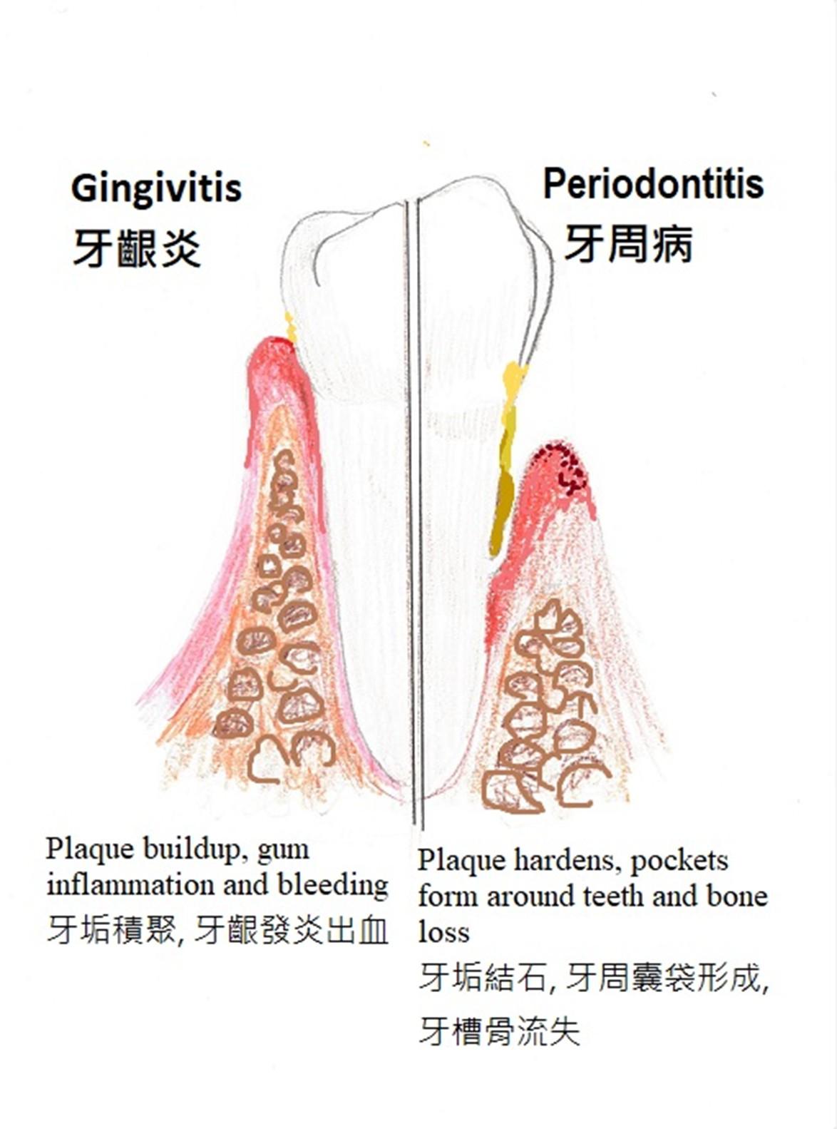 gum diseases